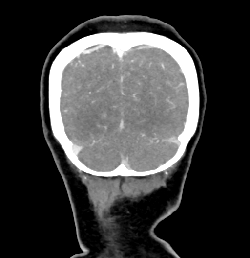 Cerebral arteriovenous malformation (Radiopaedia 73830-84645 C 85).jpg