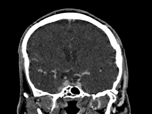 Cerebral arteriovenous malformation (Radiopaedia 78188-90746 Coronal C+ delayed 48).jpg