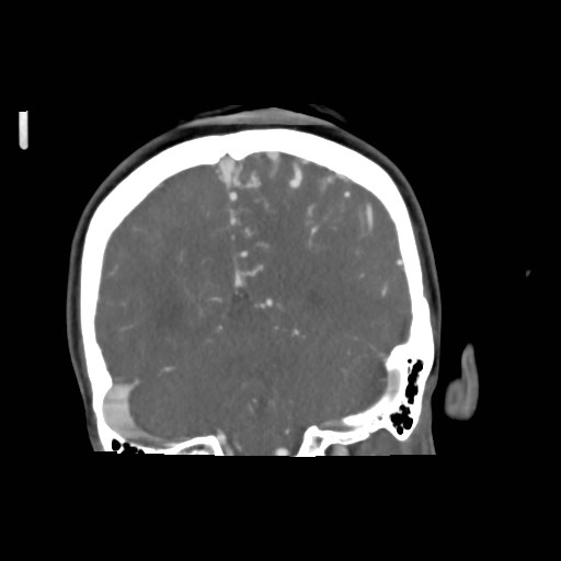 File:Cerebral arteriovenous malformation (Radiopaedia 79677-92888 B 34).jpg