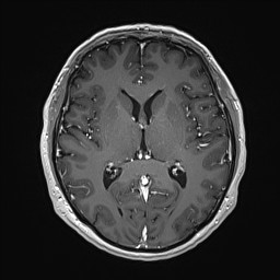 Cerebral arteriovenous malformation (Radiopaedia 84015-99245 Axial T1 C+ 83).jpg