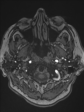 Cerebral arteriovenous malformation (Radiopaedia 84015-99245 Axial TOF 37).jpg