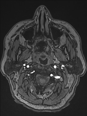 Cerebral arteriovenous malformation (Radiopaedia 84015-99245 Axial TOF 6).jpg