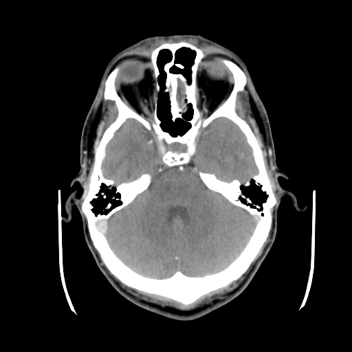 Cerebral arteriovenous malformation (Spetzler-Martin grade 2) (Radiopaedia 41262-44076 Axial C+ 15).png