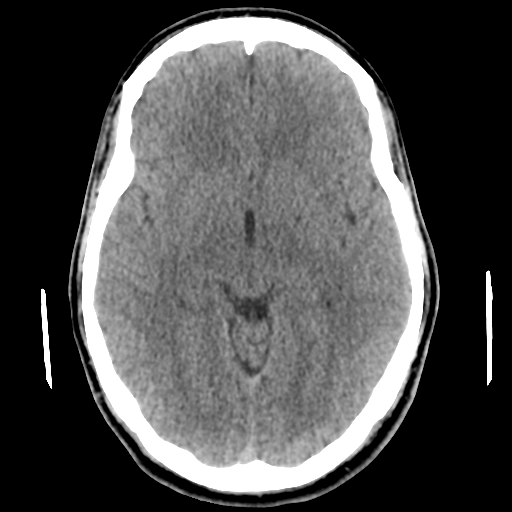 Cerebral arteriovenous malformation (Spetzler-Martin grade 2) (Radiopaedia 41262-44076 Axial non-contrast 26).png