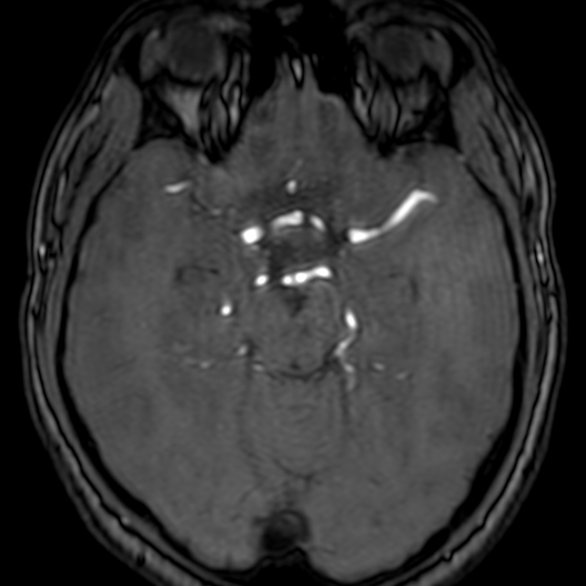 Cerebral arteriovenous malformation at posterior body of corpus callosum (Radiopaedia 74111-84925 Axial MRA 78).jpg