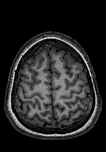 Cerebral arteriovenous malformation at posterior body of corpus callosum (Radiopaedia 74111-84925 Axial T1 38).jpg