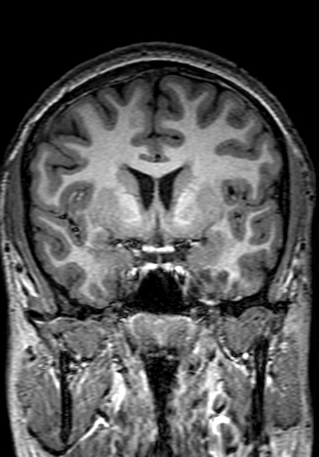 Cerebral arteriovenous malformation at posterior body of corpus callosum (Radiopaedia 74111-84925 Coronal T1 131).jpg