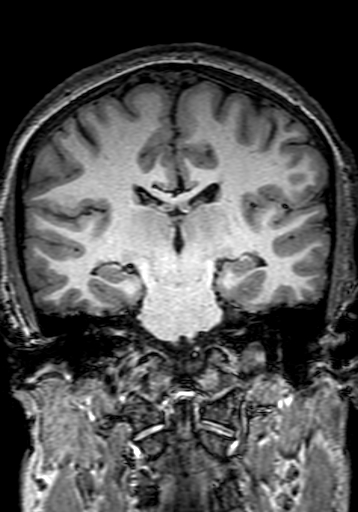 Cerebral arteriovenous malformation at posterior body of corpus callosum (Radiopaedia 74111-84925 Coronal T1 189).jpg