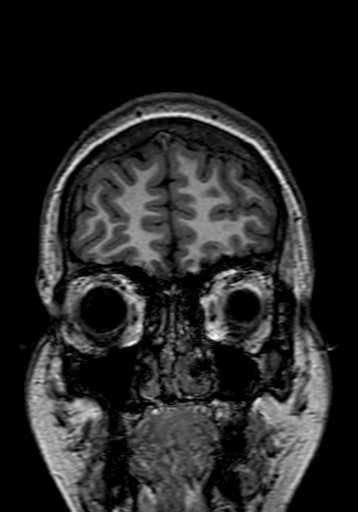Cerebral arteriovenous malformation at posterior body of corpus callosum (Radiopaedia 74111-84925 Coronal T1 23).jpg
