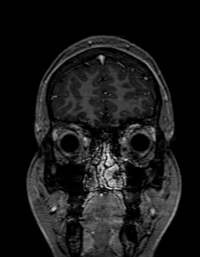 Cerebral arteriovenous malformation at posterior body of corpus callosum (Radiopaedia 74111-84925 K 44).jpg