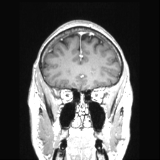Cerebral arteriovenous malformation with hemorrhage (Radiopaedia 34422-35737 Coronal T1 C+ 69).png