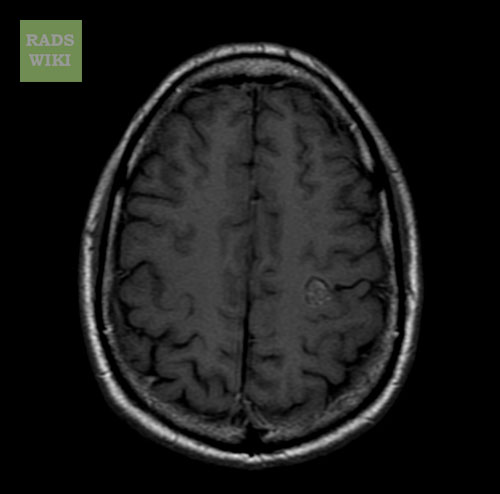 File:Cerebral cavernous malformation (Radiopaedia 11284-11648 Axial T1 1).jpg