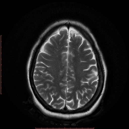 File:Cerebral cavernous malformation (Radiopaedia 26177-26306 Axial T2 16).jpg