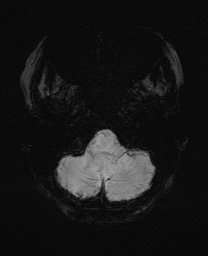 Cerebral cavernous venous malformation (Radiopaedia 70008-80021 Axial SWI 7).jpg