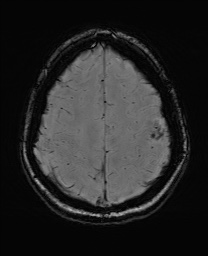 Cerebral cavernous venous malformation (Radiopaedia 70008-80021 I 59).jpg