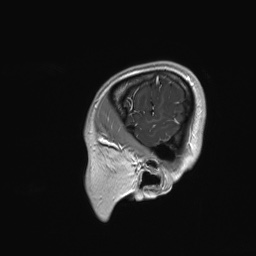 File:Cerebral cavernous venous malformation (Radiopaedia 70008-80021 Sagittal T1 C+ 68).jpg