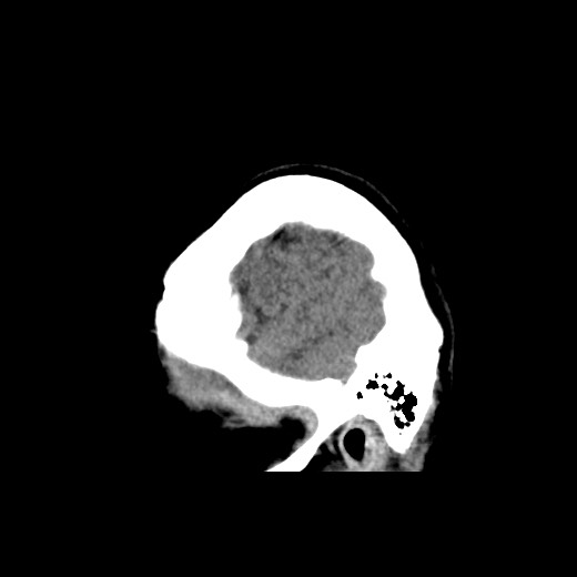 Cerebral cavernous venous malformation (Radiopaedia 70008-80022 C 53).jpg