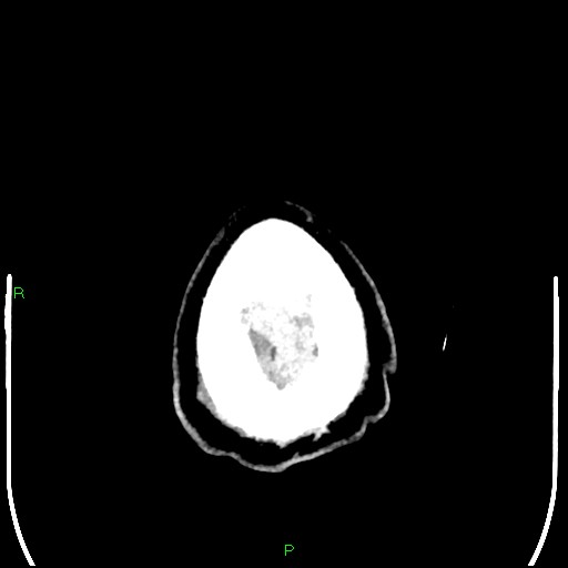 Cerebral contusions (Radiopaedia 33868-35039 Axial non-contrast 214).jpg