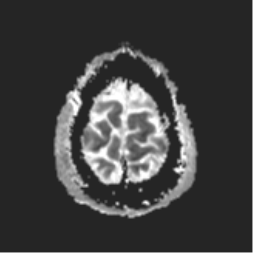 File:Cerebral embolic infarcts (embolic shower) (Radiopaedia 57395-64342 Axial ADC 33).png