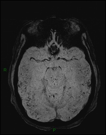 Cerebral fat embolism (Radiopaedia 35022-36525 Axial SWI 5).jpg