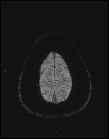 Cerebral fat embolism (Radiopaedia 35022-36525 Axial SWI 62).jpg