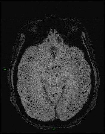 Cerebral fat embolism (Radiopaedia 35022-36525 Axial SWI 7).jpg