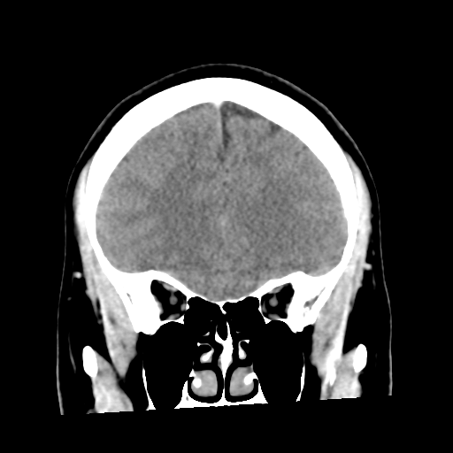 Cerebral hemorrhage secondary to arteriovenous malformation (Radiopaedia 33497-34561 C 19).png