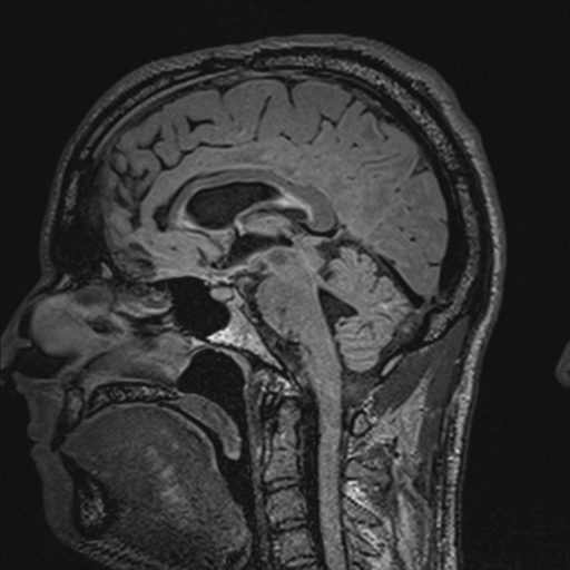File:Cerebral hemorrhagic contusions- temporal evolution (Radiopaedia 40224-42757 Sagittal T1 42).png