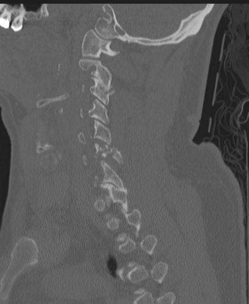 Cerebral hemorrhagic contusions and cervical spine fractures (Radiopaedia 32865-33841 Sagittal bone window 39).jpg