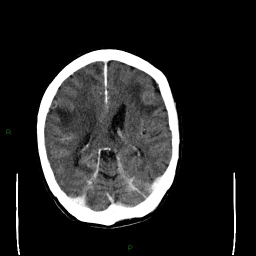 Cerebral metastases - breast primary (Radiopaedia 77653-89857 Axial C+ delayed 69).jpg