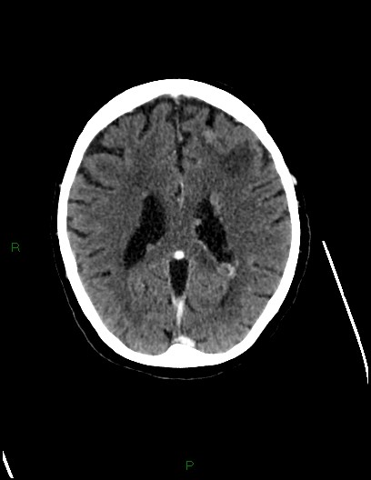Cerebral metastases - ependymal and parenchymal (Radiopaedia 79877-93131 Axial C+ delayed 53).jpg