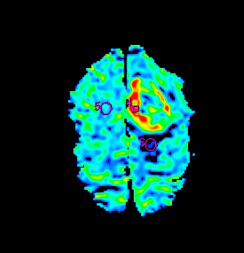 File:Cerebral metastases - renal cell carcinoma (Radiopaedia 5510-7246 D 1).jpg