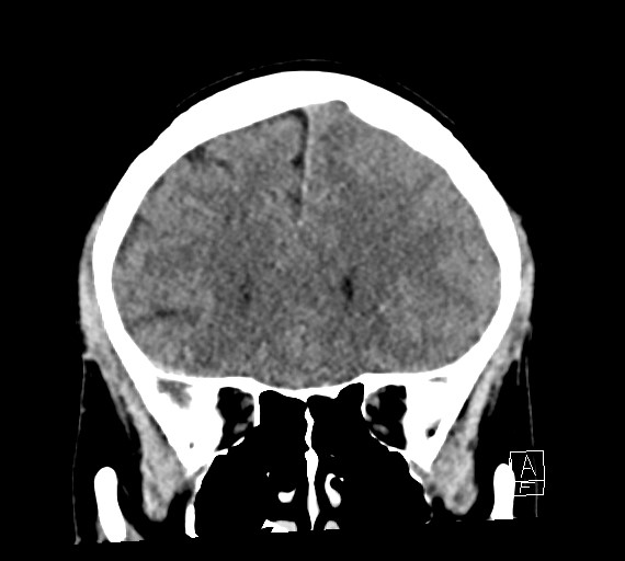 Cerebral metastases - testicular choriocarcinoma (Radiopaedia 84486-99855 Coronal C+ delayed 20).jpg