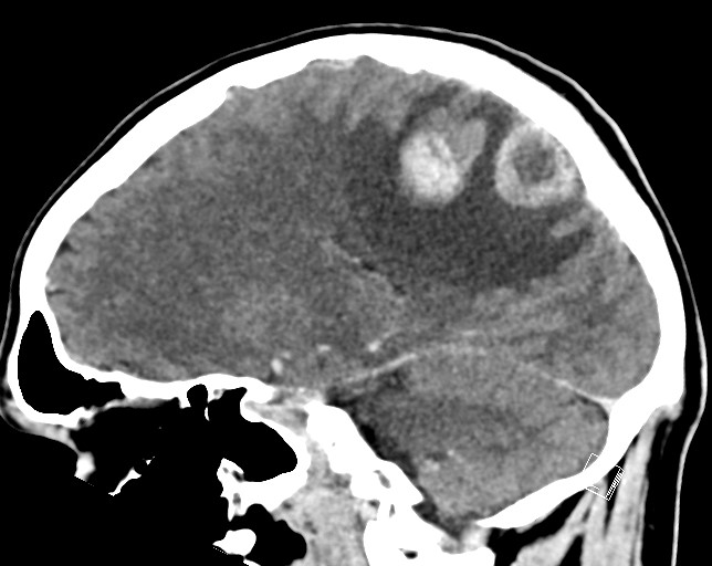 Cerebral metastases - testicular choriocarcinoma (Radiopaedia 84486-99855 F 25).jpg