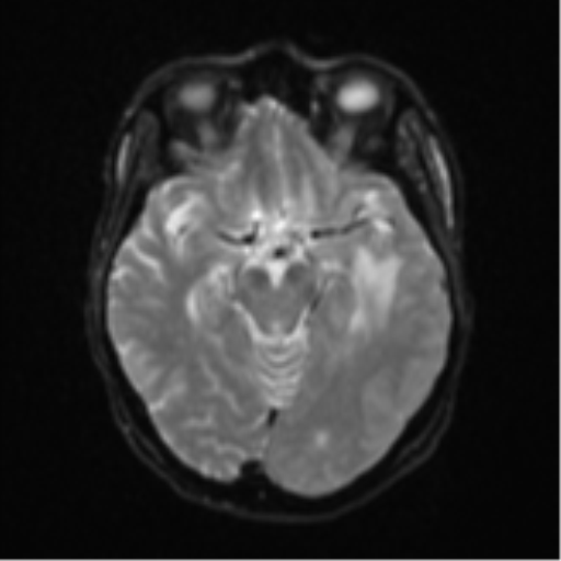 Cerebral metastasis (Radiopaedia 46744-51248 Axial DWI 11).png