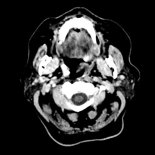 Cerebral metastasis to basal ganglia (Radiopaedia 81568-95412 Axial C+ delayed 4).png
