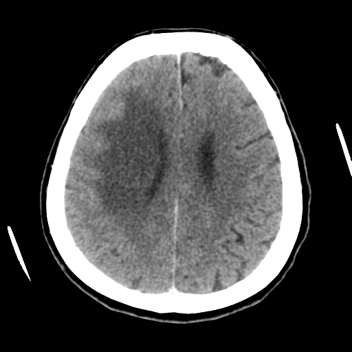 Cerebral metastasis to basal ganglia (Radiopaedia 81568-95412 Axial C+ delayed 41).png