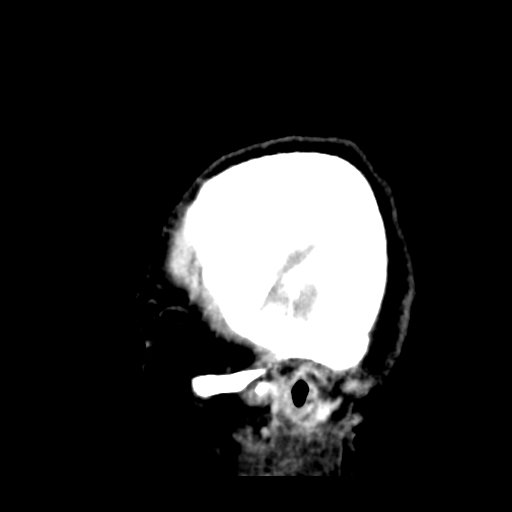 Cerebral metastasis to basal ganglia (Radiopaedia 81568-95412 Sagittal C+ delayed 51).png