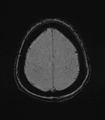 File:Cerebral metastasis to basal ganglia (Radiopaedia 81568-95413 Axial SWI 74).png