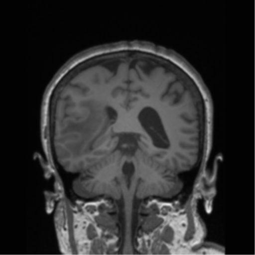 Cerebral metastasis to basal ganglia (Radiopaedia 81568-95413 Coronal T1 14).png