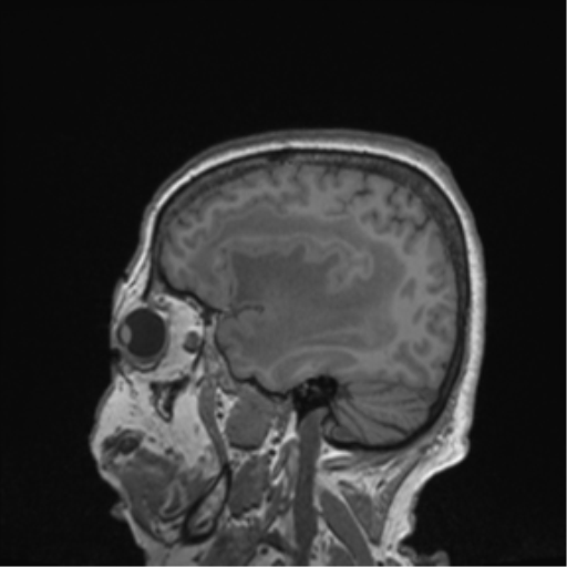 Cerebral metastasis to basal ganglia (Radiopaedia 81568-95413 Sagittal T1 59).png