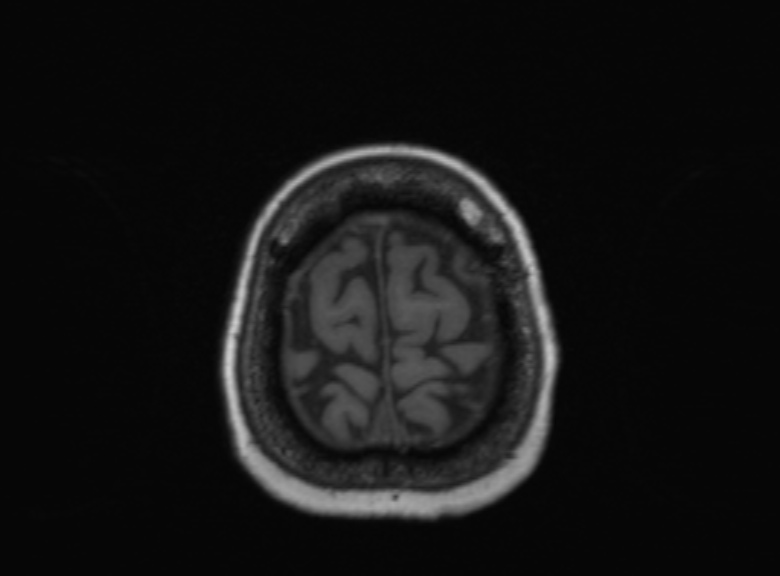 Cerebral ring enhancing lesions - cerebral metastases (Radiopaedia 44922-48817 Axial T1 117).jpg