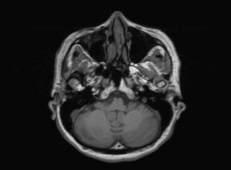 Cerebral ring enhancing lesions - cerebral metastases (Radiopaedia 44922-48817 Axial T1 313).jpg