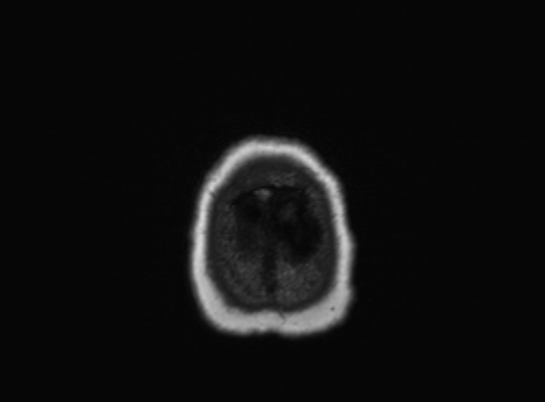 Cerebral ring enhancing lesions - cerebral metastases (Radiopaedia 44922-48817 Axial T1 92).jpg