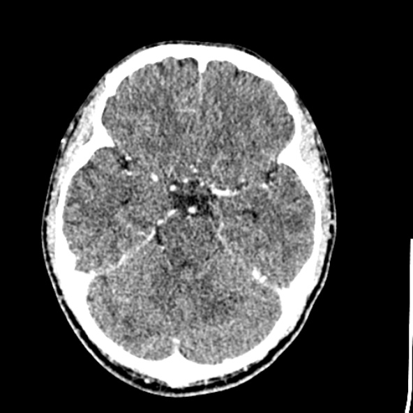 Cerebral toxoplasmosis (Radiopaedia 53993-60131 Axial C+ delayed 26).jpg