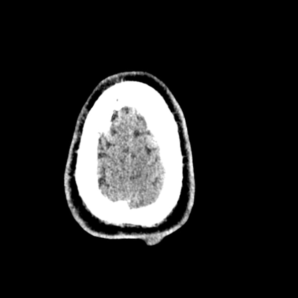 Cerebral toxoplasmosis (Radiopaedia 53993-60131 Axial non-contrast 72).jpg