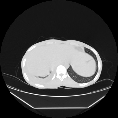 Cerebral tuberculoma (Radiopaedia 80829-94318 Axial lung window 166).jpg