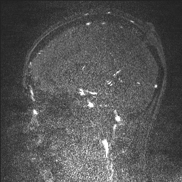 Cerebral tuberculosis with dural sinus invasion (Radiopaedia 60353-68090 Sagittal MRV 87).jpg