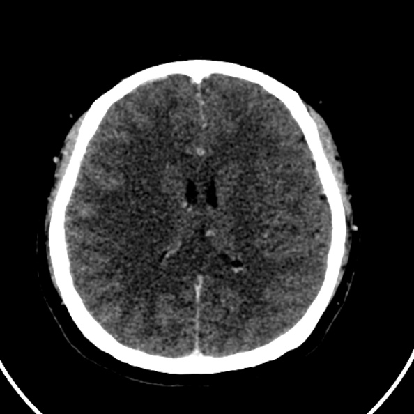 File:Cerebral venous hemorrhagic infarct from venous sinus thrombosis (Radiopaedia 55433-61883 Axial C+ delayed 65).jpg