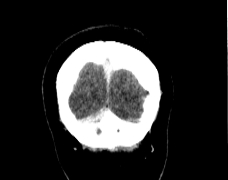 Cerebral venous hemorrhagic infarct from venous sinus thrombosis (Radiopaedia 55433-61883 Coronal C+ delayed 55).jpg